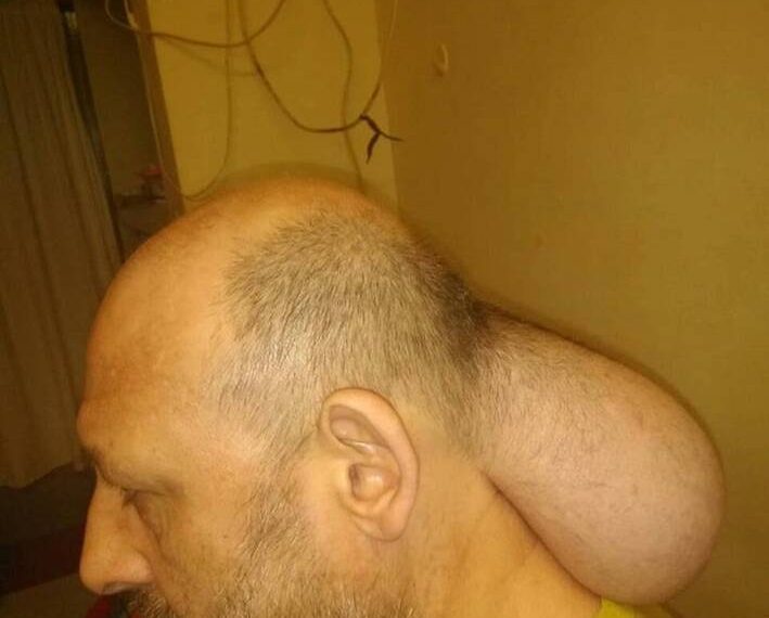 Φυλακές Νιγρίτας: Κρατούμενος έχει βγάλει “δεύτερο κεφάλι” και ζητά να χειρουργηθεί άμεσα