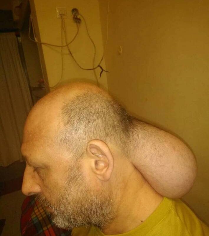 Φυλακές Νιγρίτας: Κρατούμενος έχει βγάλει “δεύτερο κεφάλι” και ζητά να χειρουργηθεί άμεσα