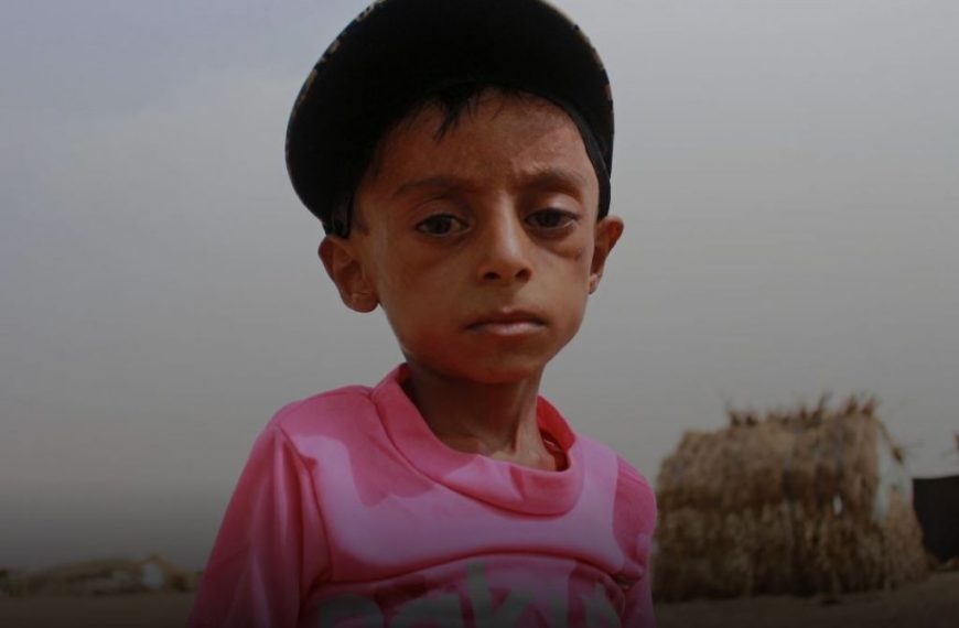 Υεμένη : Η πείνα στοιχειώνει τα παιδιά της χώρας – Η συγκλονιστική ιστορία του 10χρονου Χάσαν