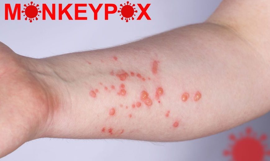 ECDC: Προειδοποιεί για αύξηση κρουσμάτων ευλογιάς των πιθήκων την άνοιξη και το&hellip;