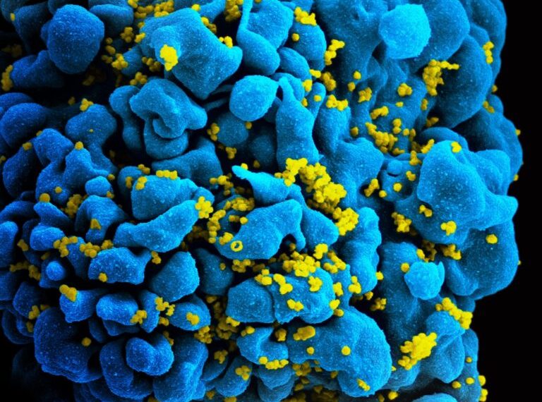 Ασθενής θεραπεύτηκε από τον ιό του AIDS μετά από μεταμόσχευση φυσιολογικών βλαστοκυττάρων