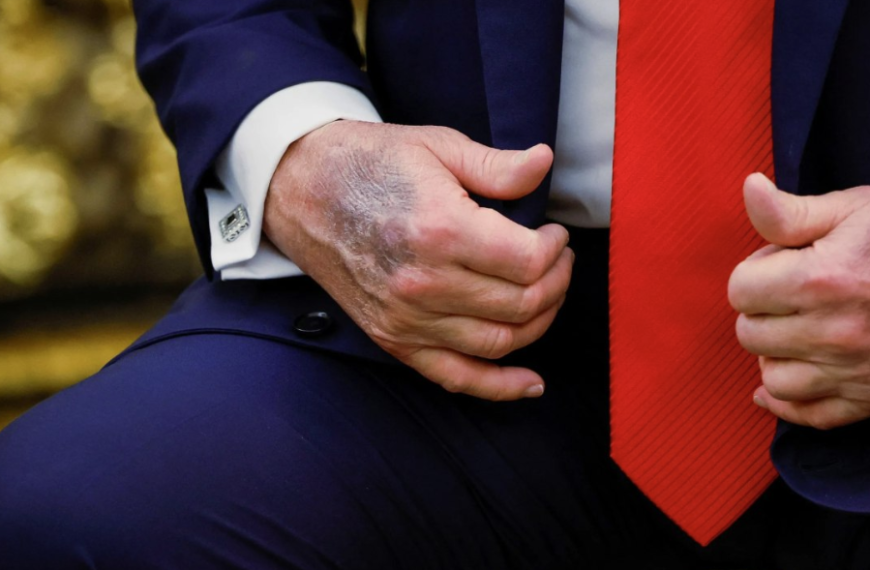 Ερωτήματα για την υγεία του Ντόναλντ Τραμπ μετά…